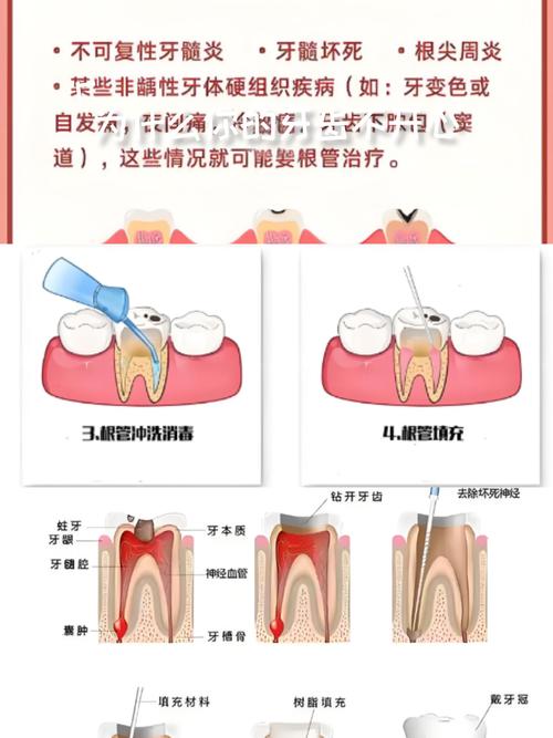 根管治疗种牙区别_牙根治疗管种是怎么做的_根管治疗是种牙吗