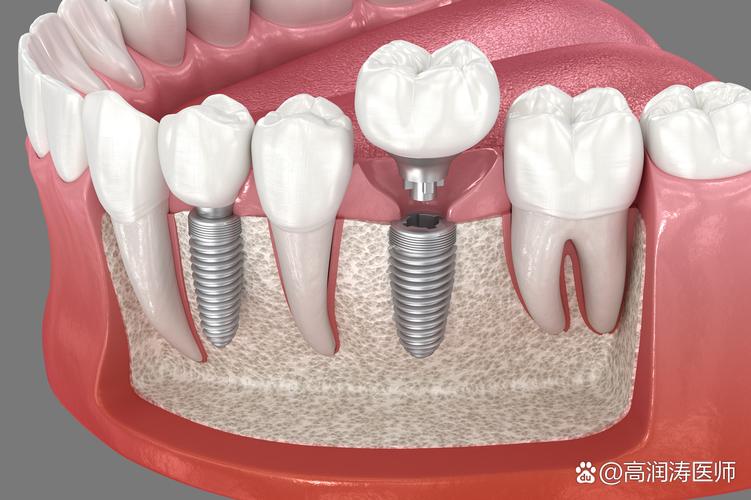 中山种植牙费用 单颗 5000-8000 元_中山市哪里种牙技术最好_中山种植牙价钱