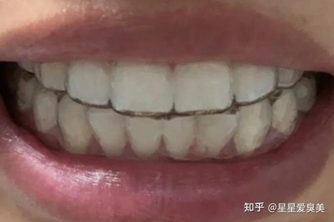 杭州24岁矫正牙齿要花多少钱 这笔钱到底值不值