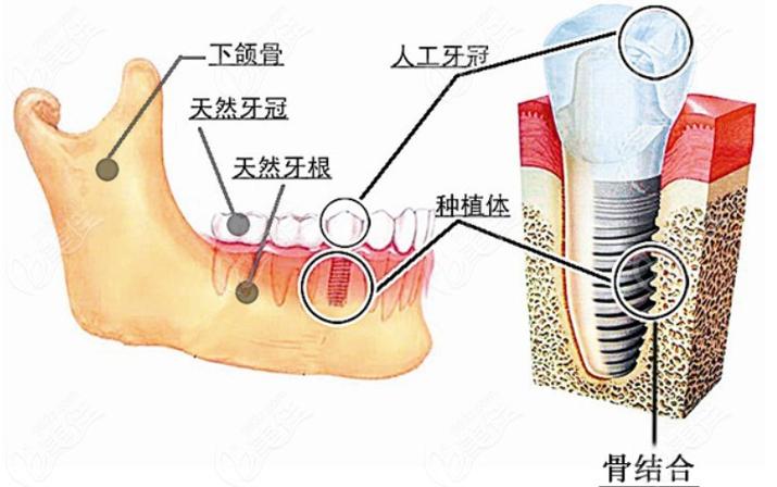 杭州深圳瑞士ITI种植牙 牙槽骨条件要求详解