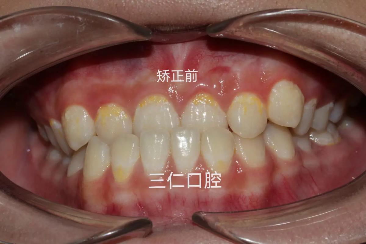 杭州种一颗牙矫正价格是多少 看完这篇心里有数