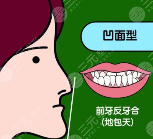 杭州深圳儿童地包天矫正多少钱？2026最新价格表来了