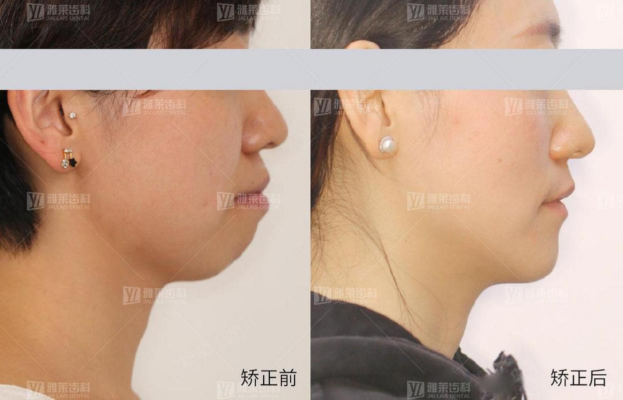 杭州矫正牙齿对脸型的改变到底有多大？真实对比告诉你