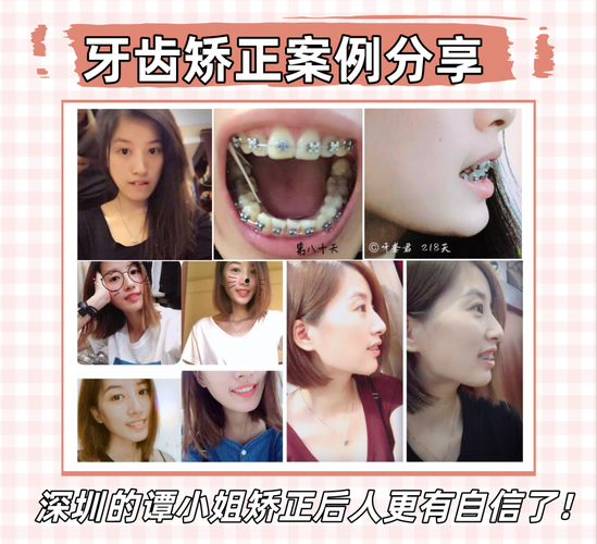 杭州深圳福田成人地包天正畸医院怎么选？看完这篇不踩坑