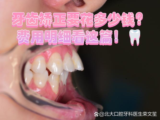 杭州广州牙齿矫正到底要花多少钱？看完这篇不踩坑