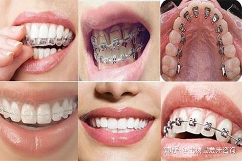 杭州34岁做牙齿矫正还来得及吗