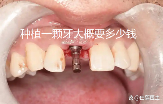 杭州纯钛种牙多少钱一颗？费用明细和影响因素都在这里