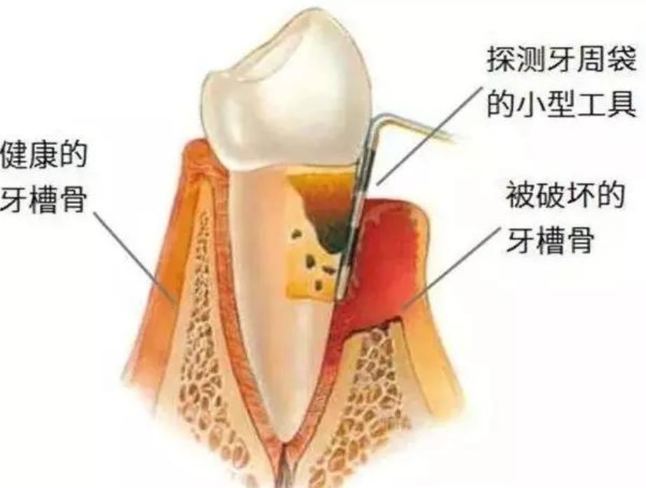 杭州深圳牙槽骨太薄种牙有救吗？医生说实话