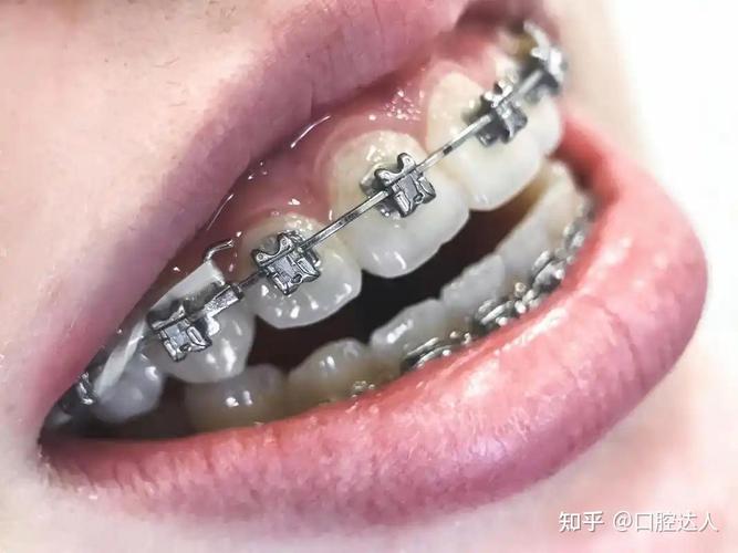 杭州矫正牙齿到底要花多少钱