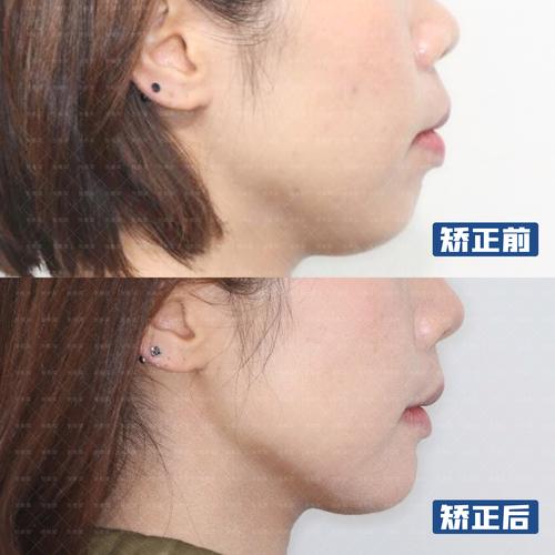 杭州35岁牙齿还能矫正吗 成人矫正效果看这里