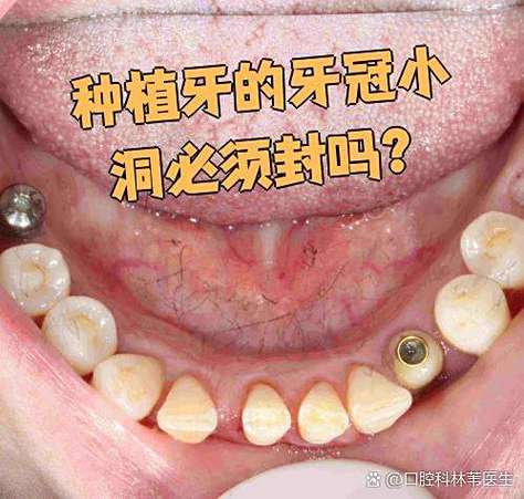 杭州深圳龙华全口种牙当天戴牙冠靠谱吗