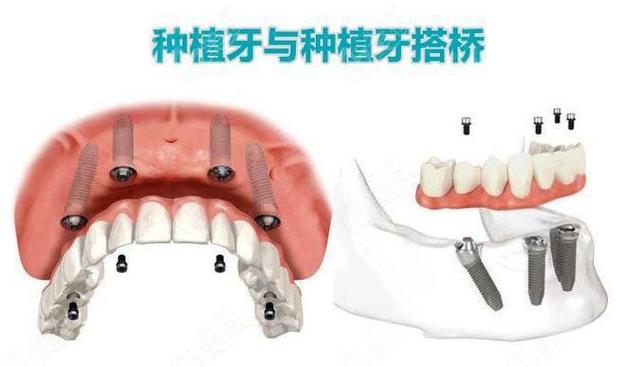 杭州种植牙还是搭桥哪个更好