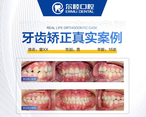 杭州深圳宝安换牙矫正多少钱？各项目详细价格参考