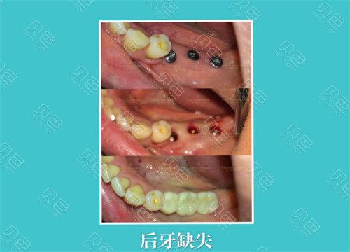 杭州龙岗中心城种植牙医院怎么选 本地人的真实推荐