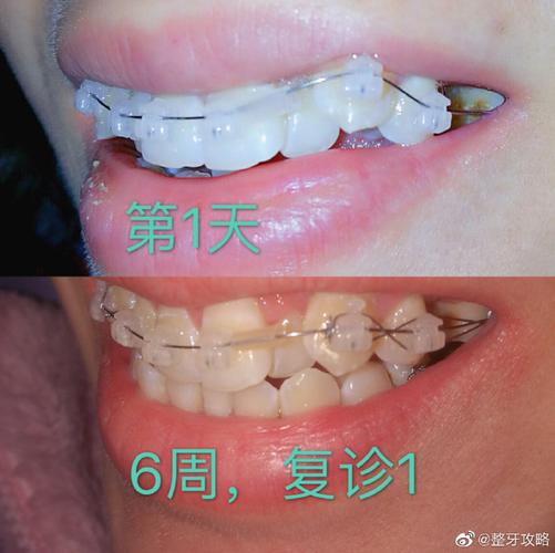 杭州深圳牙缝过大矫正多少钱 价格表一览