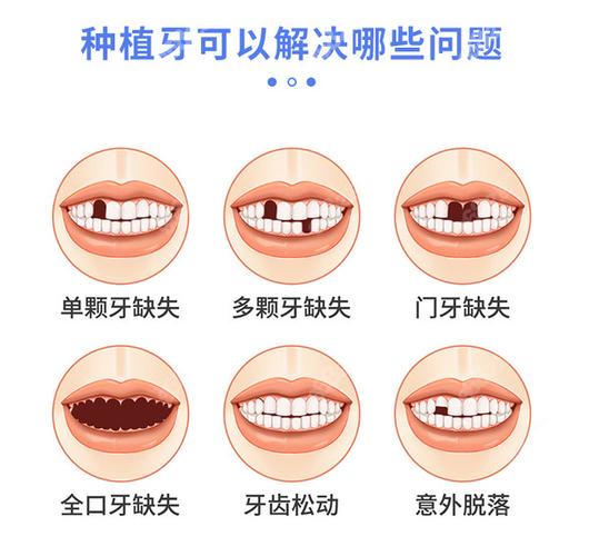 杭州宝安新安种植牙哪家医院好？靠谱选择看这几点