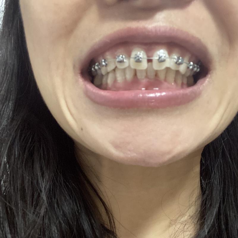 杭州40岁还能矫正牙齿吗？真实案例告诉你答案