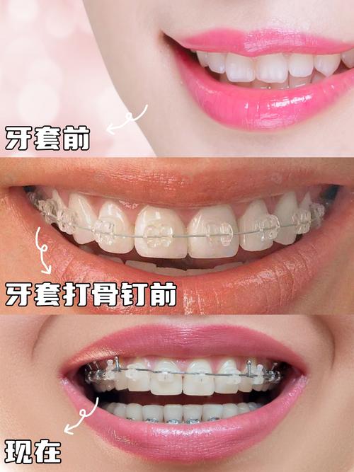 成年人 牙齿矫正_成人牙齿矫正_成人矫正牙齿有年龄限制吗