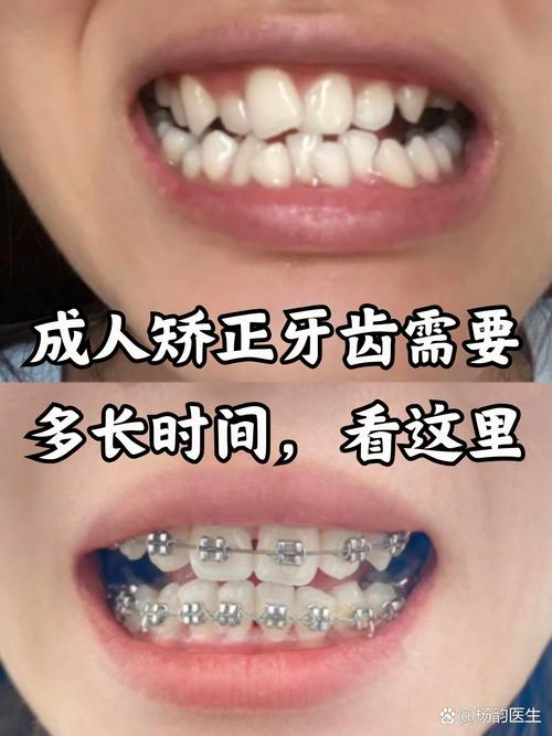 杭州41岁做牙齿矫正晚不晚？成人正畸真实经历分享
