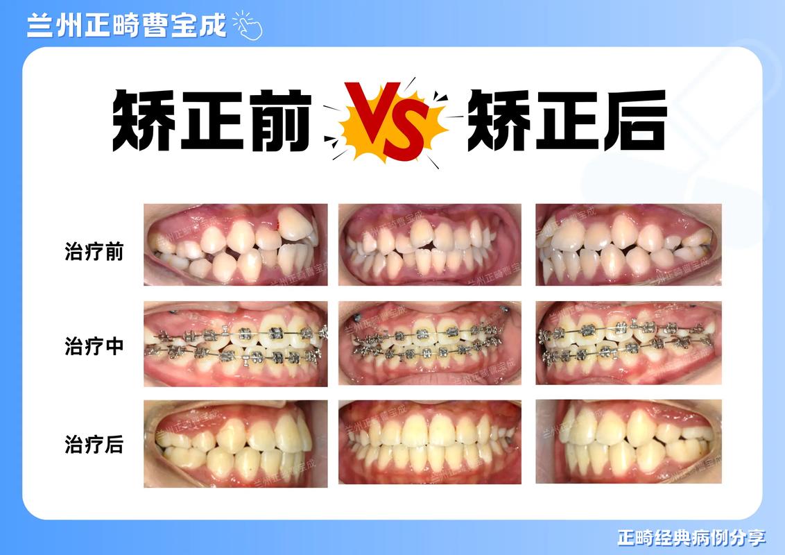 杭州20岁矫正牙齿的利与弊 成年人整牙值不值