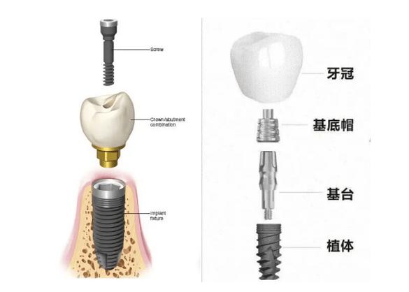 杭州种牙全过程要多久？看完心里有数