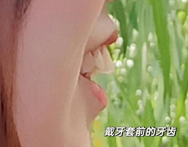 杭州深圳骨性龅牙正畸选哪家医院？骨科正畸避坑全攻略