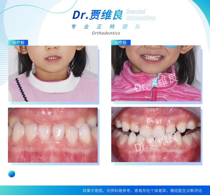 杭州儿童牙齿校正几岁开始做合适？
