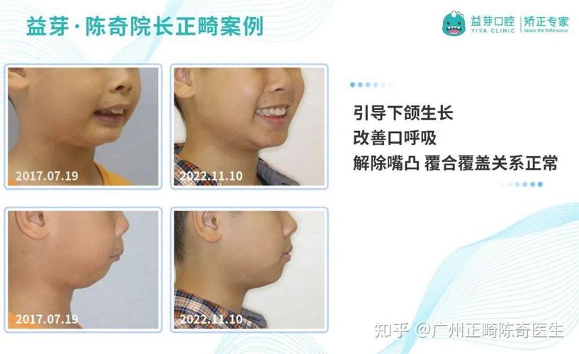 杭州东莞儿童牙齿矫正几岁开始最好？家长别等换完牙才后悔