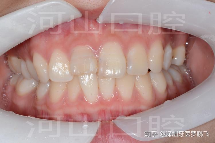 杭州20岁牙齿还能不能矫正？成年人正畸真实情况揭秘