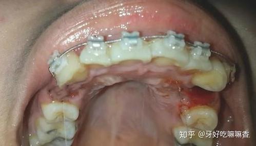 杭州宁波青少年牙齿矫正选哪家？费用多少？看完这篇就明白