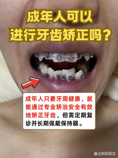杭州30岁矫正牙齿还来得及吗 成年人正畸必看