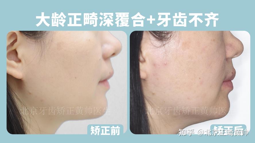 杭州45岁做深覆合矫正大概多少钱？费用明细全公开