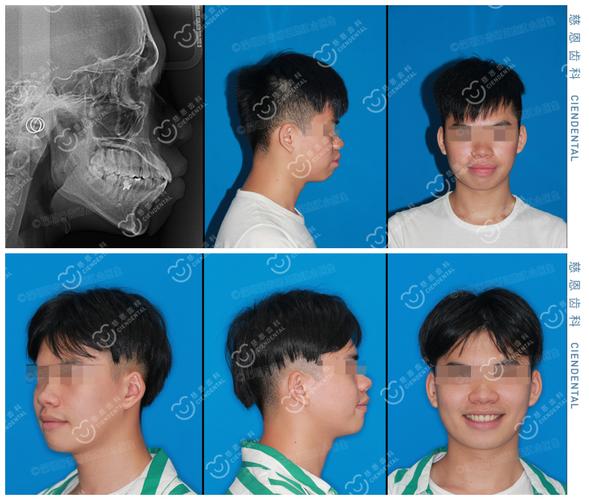 杭州深圳罗湖骨性龅牙隐形矫正能行吗?方案详解