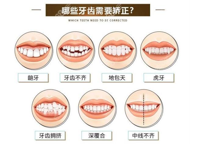 杭州深圳儿童地包天几岁矫正最好