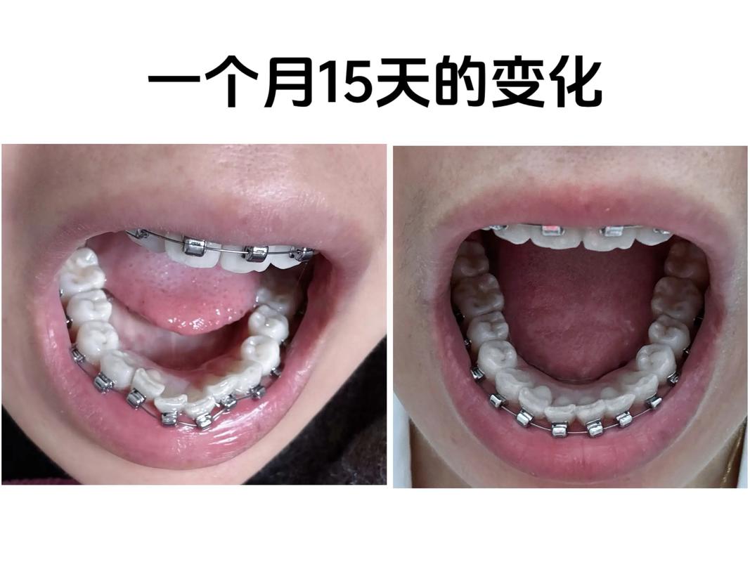 杭州30岁还能做牙齿矫正吗 成年正畸晚不晚