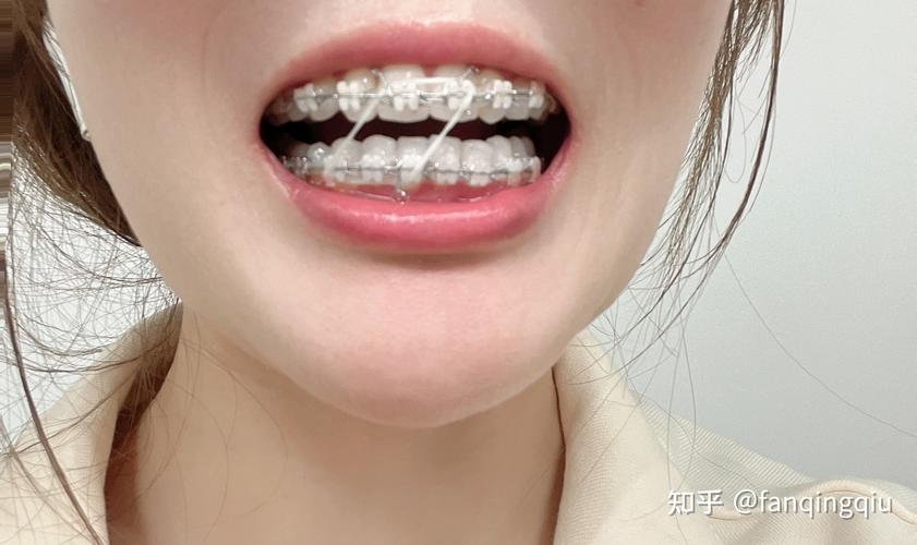 杭州27岁做牙齿矫正还来得及吗