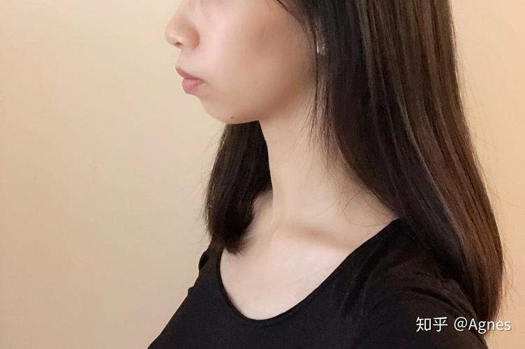 杭州深圳龙岗隐适美矫正要多久？看完这篇就清楚了