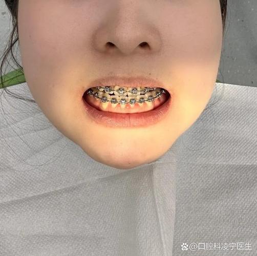 杭州50岁门牙突出还能整吗？牙医说了实话