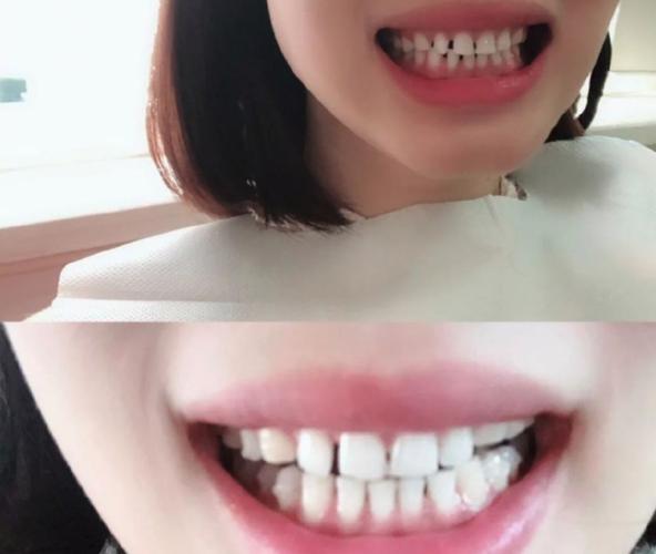 杭州成都钢丝矫正牙齿要多少钱？真实价格全曝光