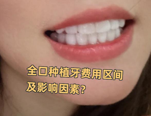 杭州深圳罗湖骨量不足全口种牙大概多少钱