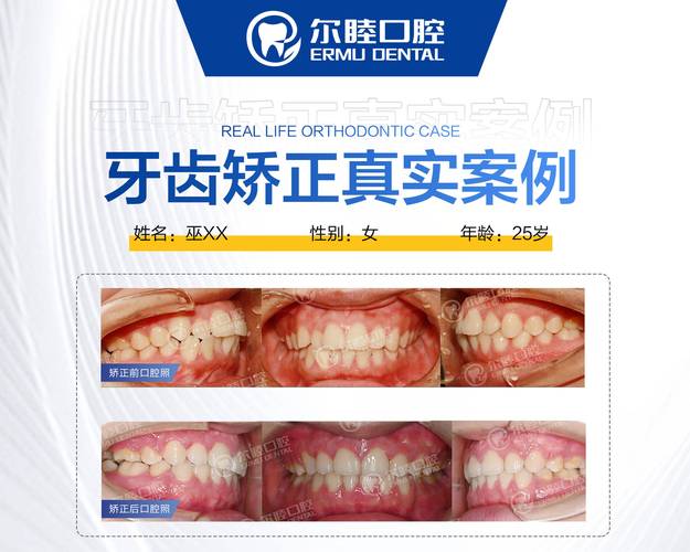 杭州深圳宝安金属自锁托槽矫正哪里好？公立和私立医院怎么选