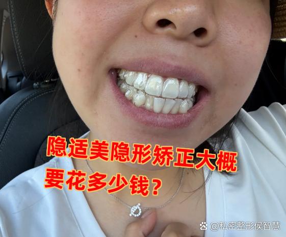 杭州深圳龙岗隐适美牙套多少钱?收费明细看这篇