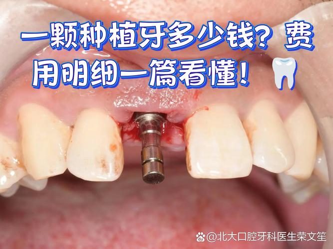 杭州深圳种牙贵不贵？揭秘诺贝尔种植牙门诊真实收费明细