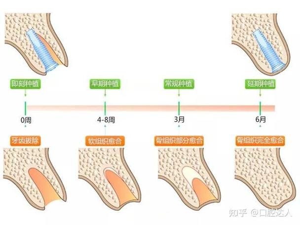 杭州掉3颗牙怎样种植?种牙流程全解析+费用避坑指南
