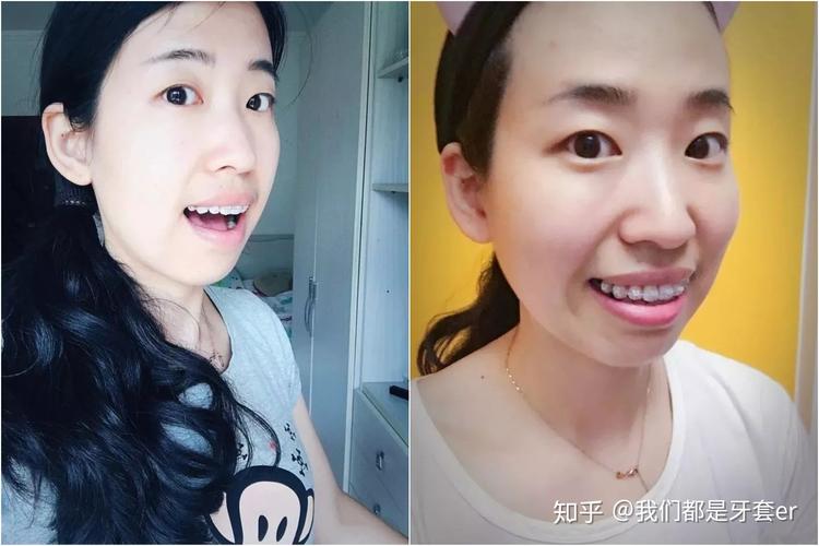 杭州30岁做牙齿矫正晚不晚?真实情况告诉你
