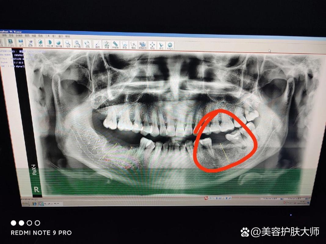杭州深圳皓圣种植牙医院靠谱吗 真实推荐指南