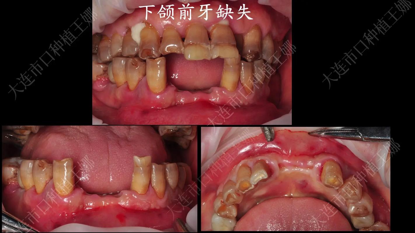 杭州拔前牙能整好牙吗？真相与风险全解析