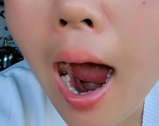 杭州55岁种牙好还是镶牙好？一文告诉你答案