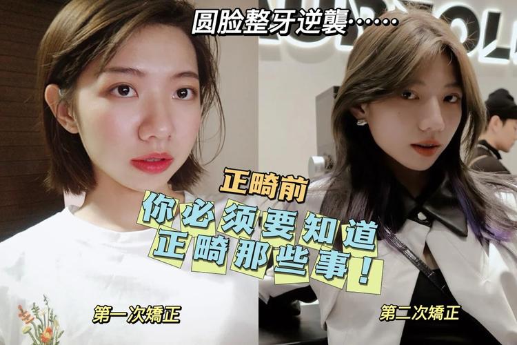 杭州23岁整牙还来得及吗?过来人说实话