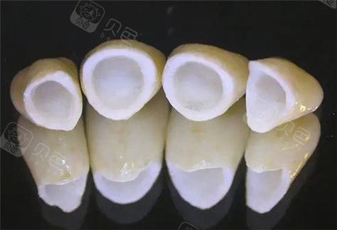 杭州深圳做全瓷牙到底要花多少钱？2026年最新报价揭秘